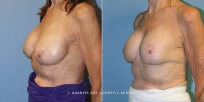 breast-implant-revision-9305b-clark