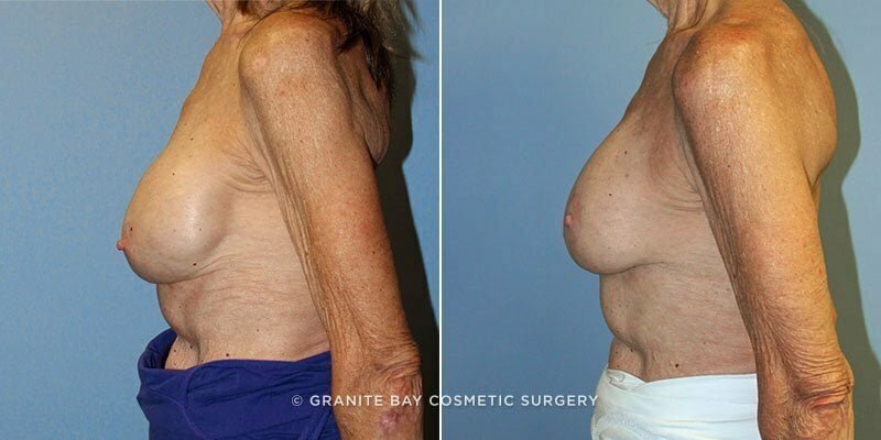 breast-implant-revision-9305c-clark