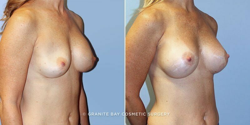 breast-implant-revision-9594b-clark