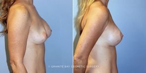 breast-implant-revision-9594c-clark