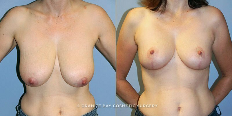 Breast Reduction & Lift