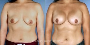 breast-lift-with-augmentation-9231a-clark