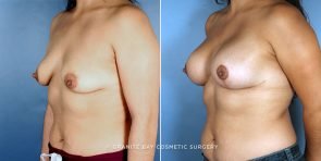 breast-lift-with-augmentation-9231b-clark