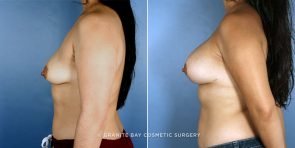 breast-lift-with-augmentation-9231c-clark