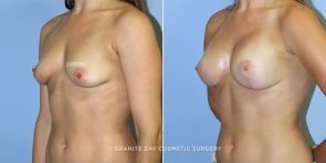 breast-lift-with-augmentation-9410b-clark
