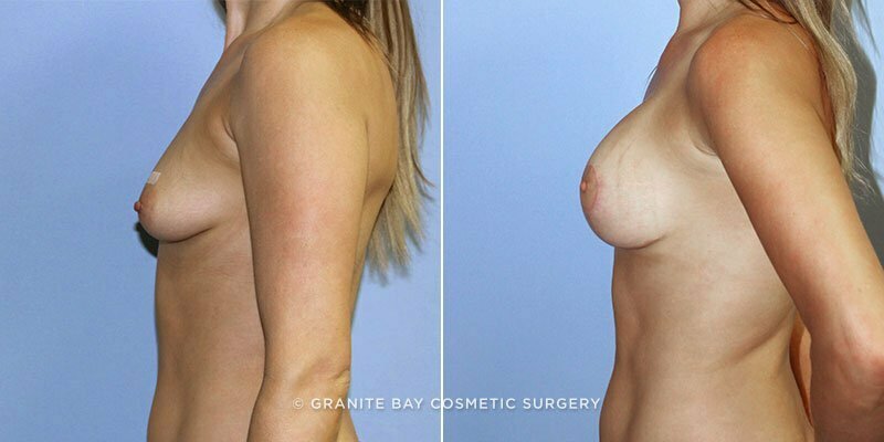 breast-lift-with-augmentation-9410c-clark