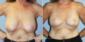 breast-lift-with-augmentation-9417a-clark