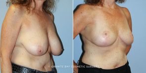 breast-lift-with-augmentation-9417b-clark