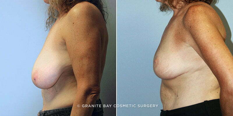 breast-lift-with-augmentation-9417c-clark