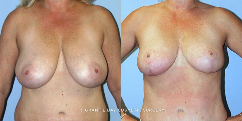 Breast Reduction