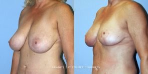breast-reduction-9277b-clark