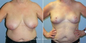 breast-reduction-9673a-clark