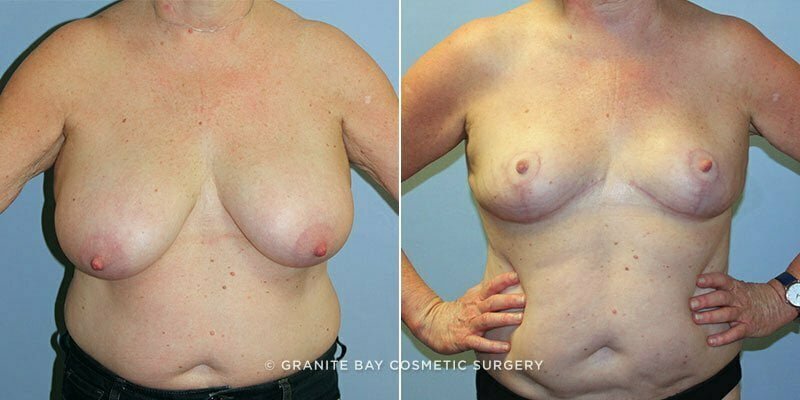 Breast Reduction