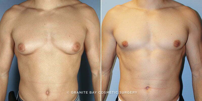 Male Breast Reduction