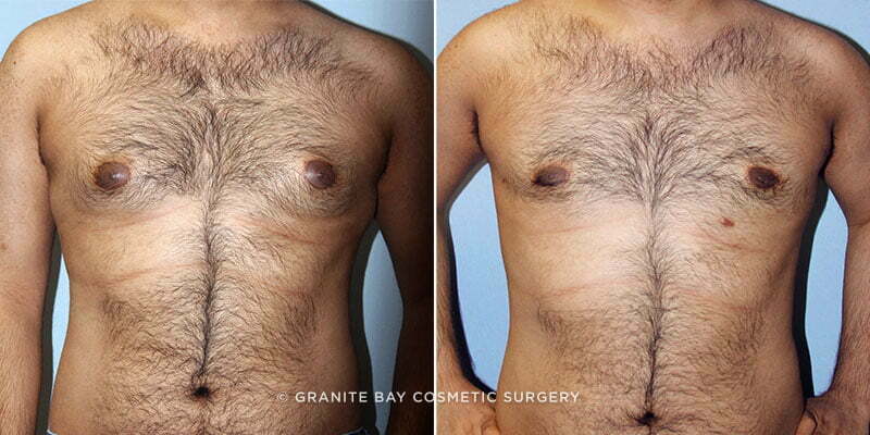 Male Breast Reduction