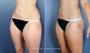 liposuction-thighs-9189b-clark