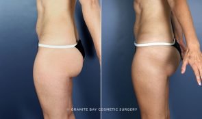 liposuction-thighs-9189c-clark