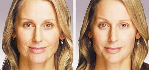 Before & after Juvéderm injections. Photos courtesy Allergan, inc.