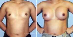 breast-augmentation-14499a-clark
