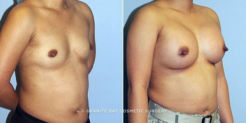 breast-augmentation-14499b-clark