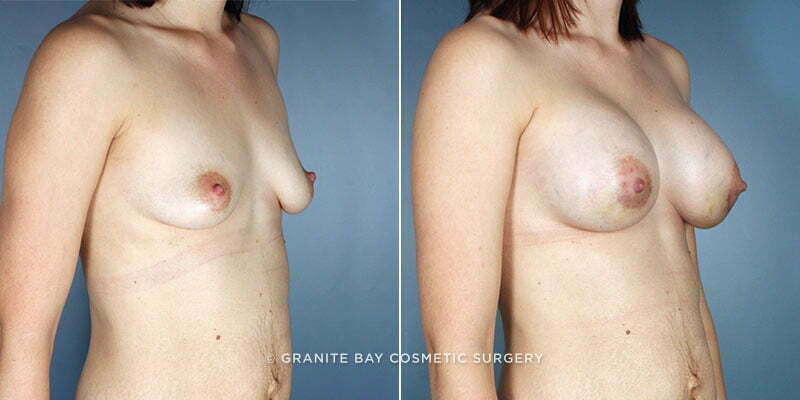breast-augmentation-7647b-Clark