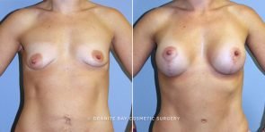 Breast Lift with Implants