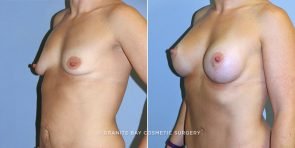 breast-lift-with-augmentation-14610b-clark