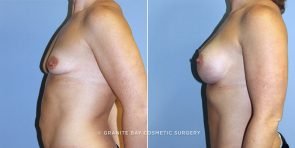 breast-lift-with-augmentation-14610c-clark