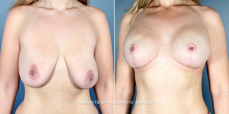 breast-lift-with-augmentation-19633a-clark