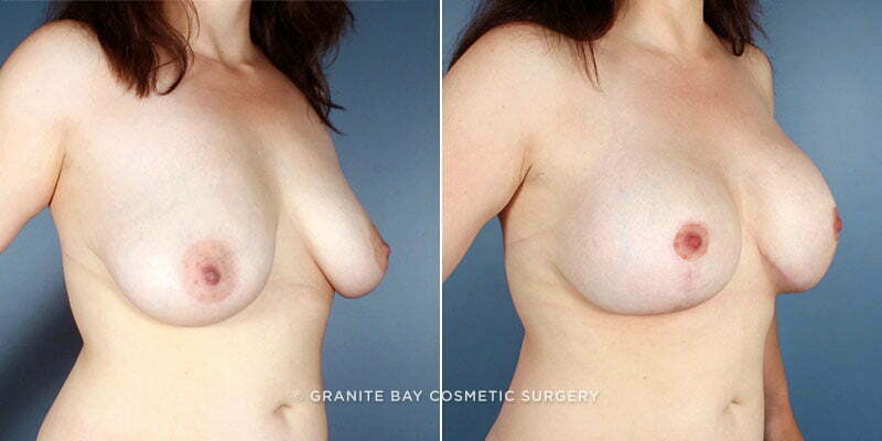 breast-lift-with-augmentation-7862b-Clark