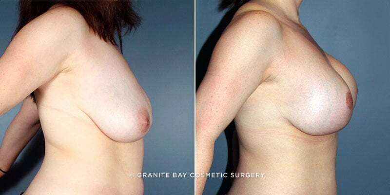 breast-lift-with-augmentation-7862c-Clark