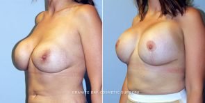 breast-revision-mastopexy-aug-13630b-clark