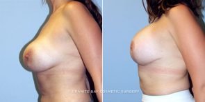 breast-revision-mastopexy-aug-13630c-clark