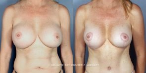 breast-revision-mastopexy-aug-3229a-Clark