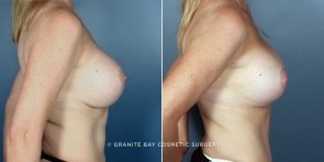 breast-revision-mastopexy-aug-3229c-Clark