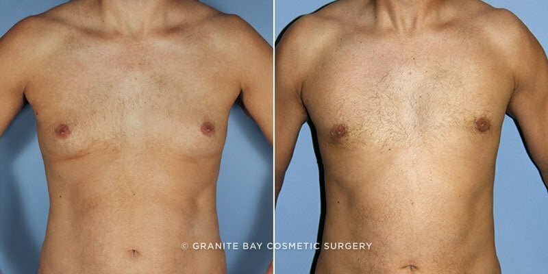 Male Breast Reduction