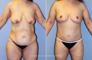 abdominoplasty-breast-mastopexy-augmentation-13308a-clark