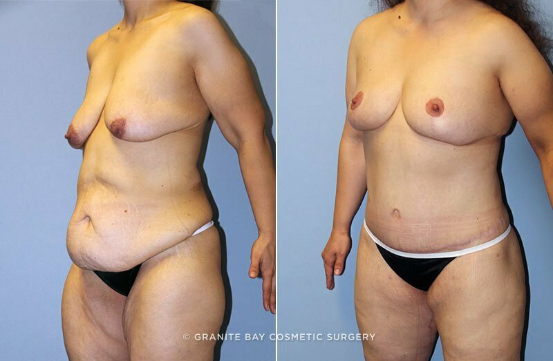 abdominoplasty-breast-mastopexy-augmentation-13308b-clark