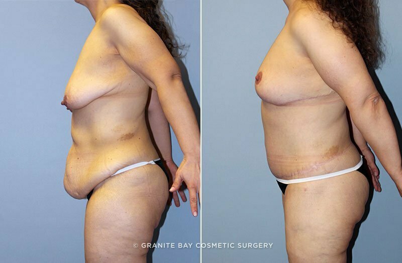 abdominoplasty-breast-mastopexy-augmentation-13308c-clark