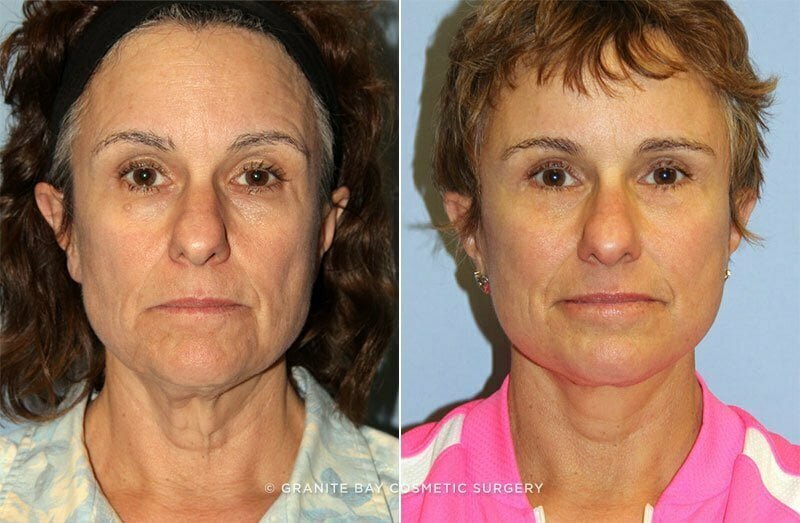 Facelift, Upper and Lower Eyelids