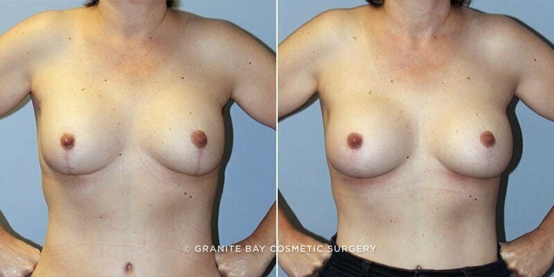 revision-breast-lift-13519a-clark,jjpg
