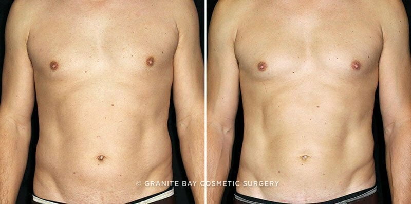 CoolSculpting