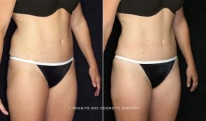 liposuction-flanks-7236b-clark