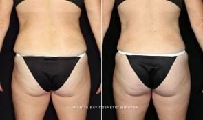 liposuction-flanks-7236d-clark