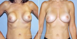 revision-breast-augmentation-18825a-clark