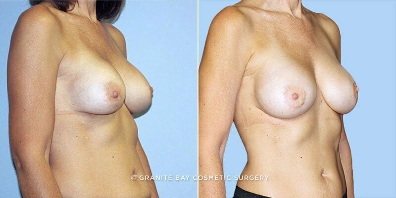 revision-breast-augmentation-18825b-clark