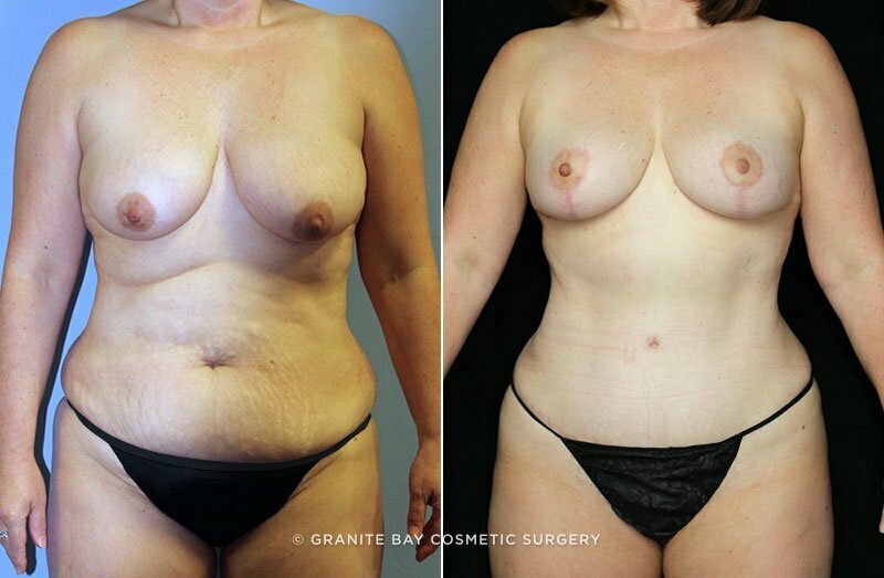 abdominoplasty-breast-lift-19097a-clark