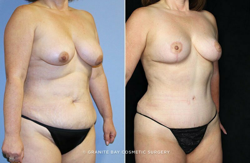abdominoplasty-breast-lift-19097b-clark