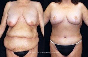 abdominoplasty-breast-lift-19544a-clark