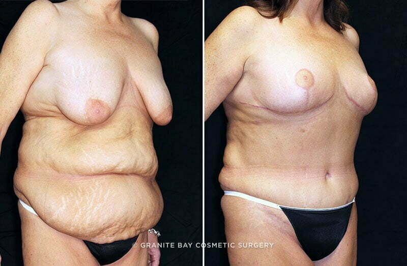 abdominoplasty-breast-lift-19544b-clark
